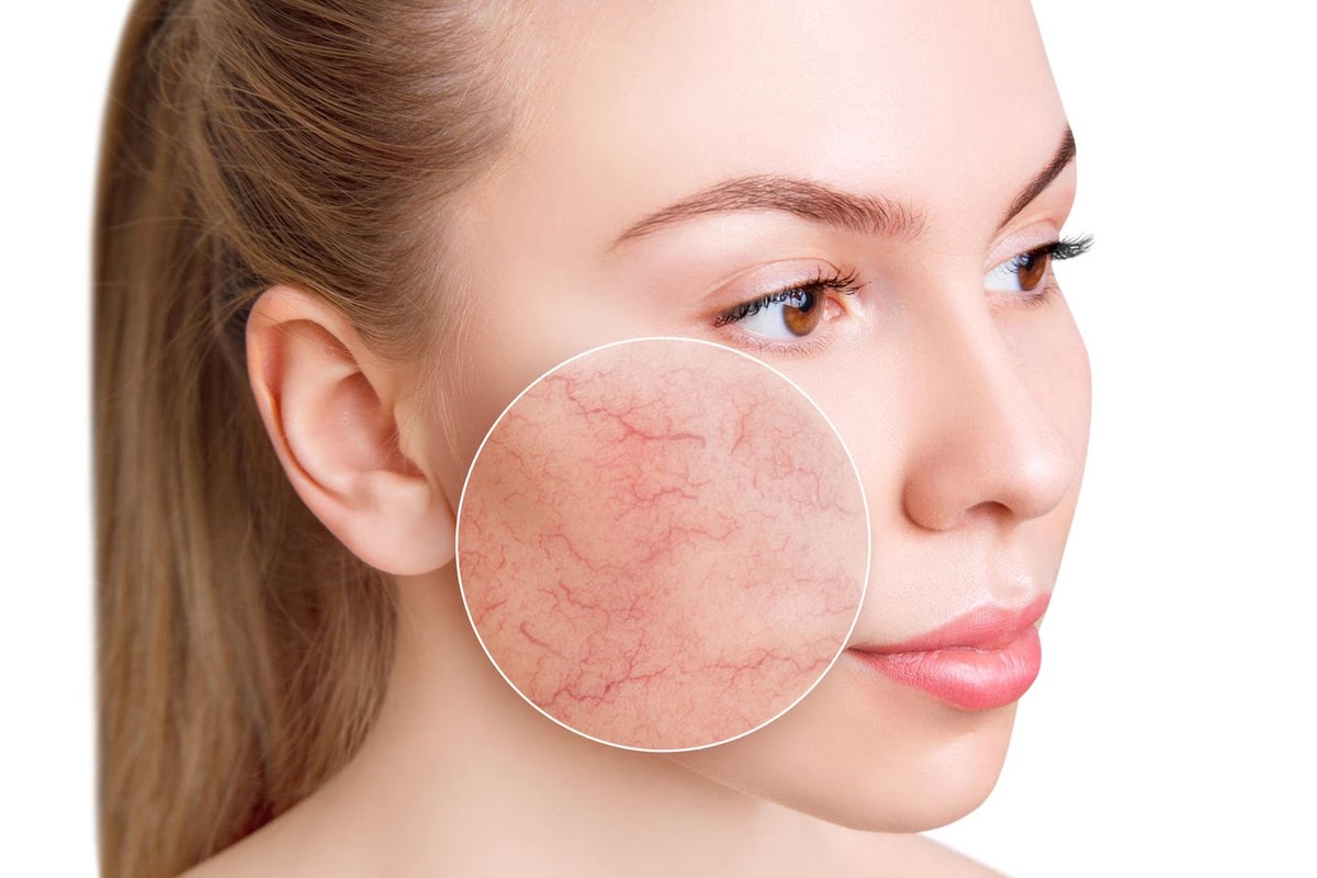 couperosa-rosacea-kezeles-beige-kozmetika